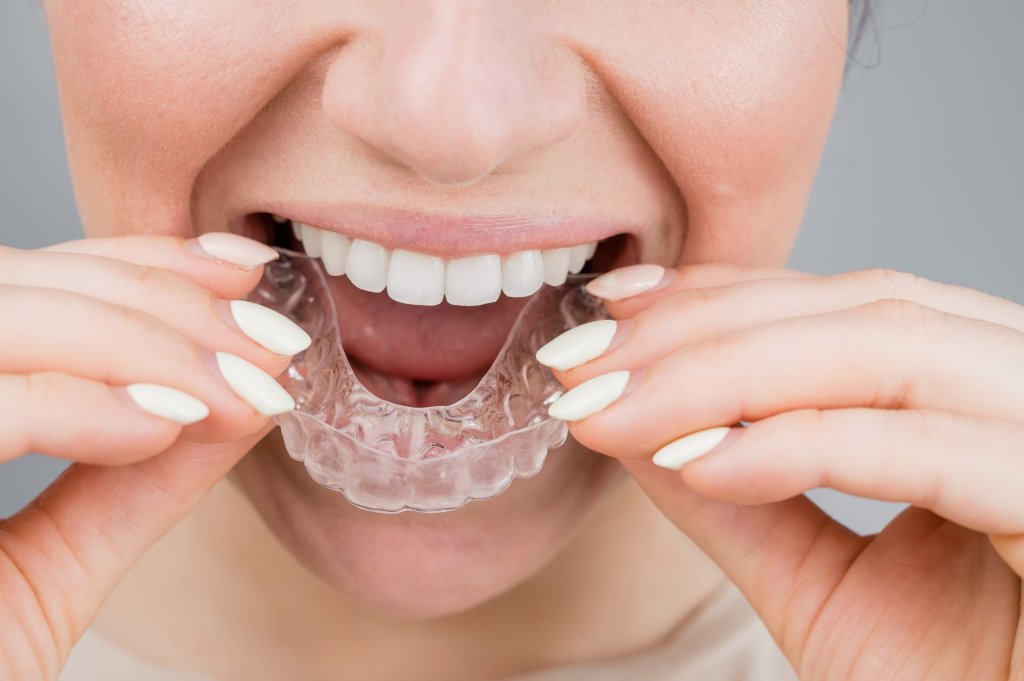 clarity aligners milton cosmetic dentistry
