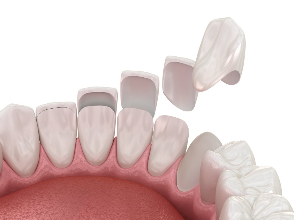 veneers cosmetic dentist