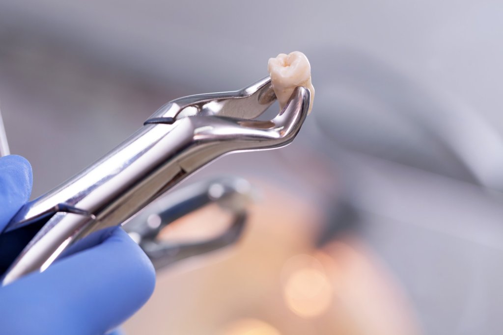 tooth extractions Delaware dentist